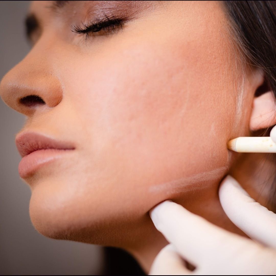 masseter botox
