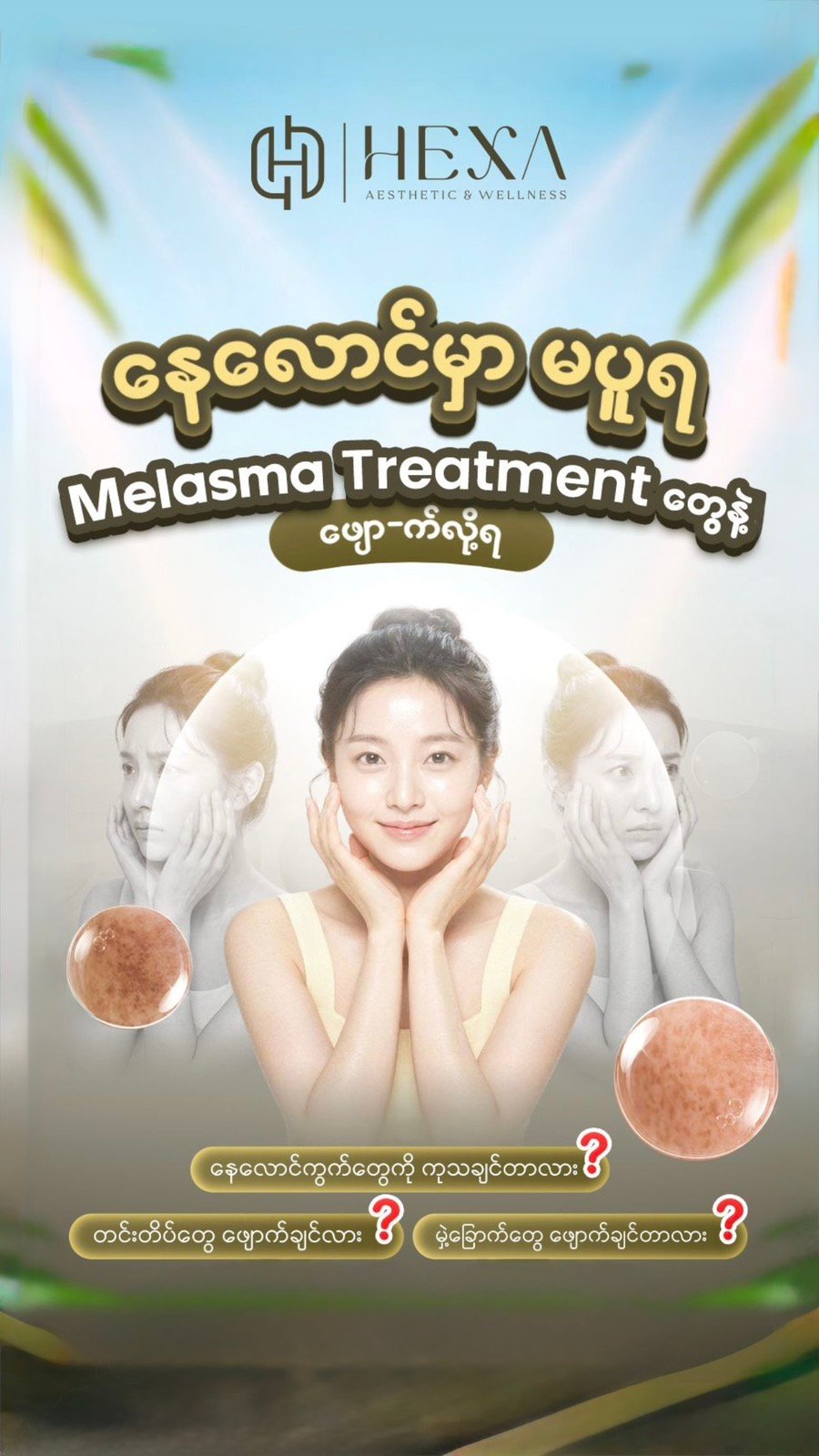 melasma final
